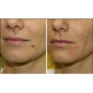 Mole Removal CO2 Fractional Laser Machine , CO2 Laser Machine For Acne Scars