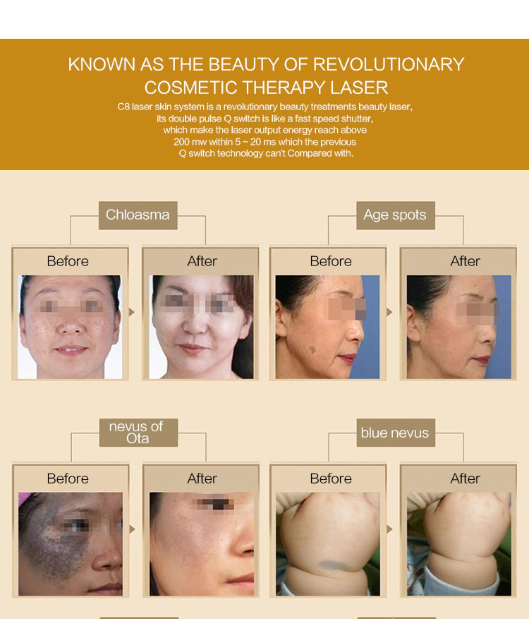 C8 Nd yag laser for freckles pigment age spots removal beauty machine