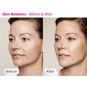 Skin Rejuvenating PDRN Skinbooster Meso Serum For Collagen Regeneration