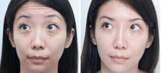 Skinject Hyaluronic Acid Dermal Filler 1ML Facial Filling Lip Enlargement