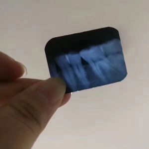 Imaging Handheld Digital Teeth X Ray Machine Wireless Medical Equipment