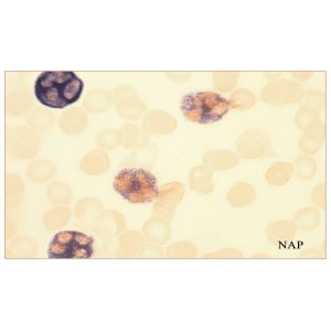 Neutrophilic- Leukocyte Alkaline Phosphatase Stain