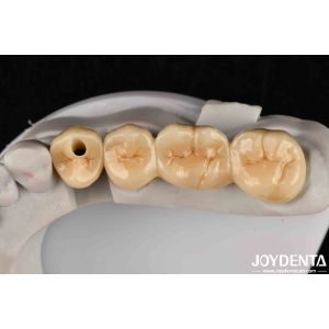 Multilayer Full Zirconia High Resistance To Cracking And Durability For Long