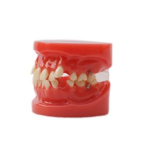 Training Use Dental Teeth Teaching Model Functional Dental Orthodontic Model
