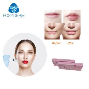 Fosyderm Hyafilia 2ml Lip Filler Hyaluronic Acid Gel Injection