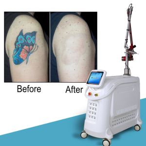 Stationary Style Picosecond Laser Machine 2000W Q Switched Nd YAG Laser Tattoo
