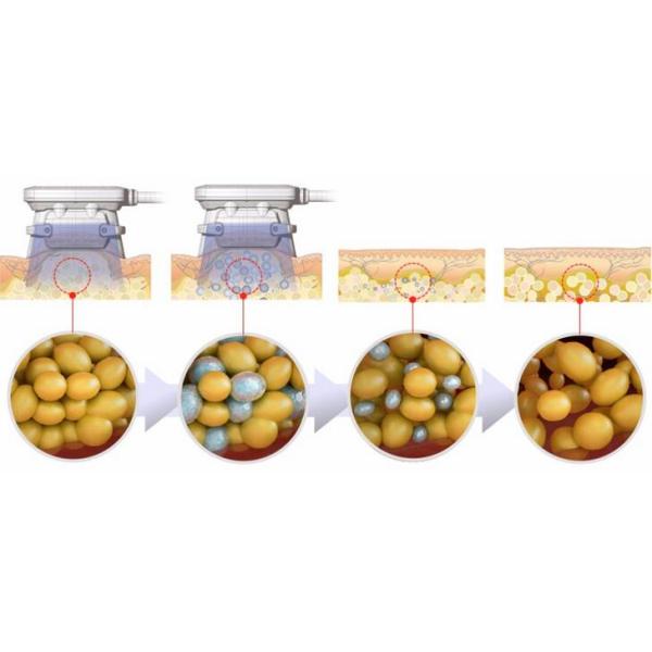 Beauty Salon Mini Cryolipolysis Fat Freezing Machine