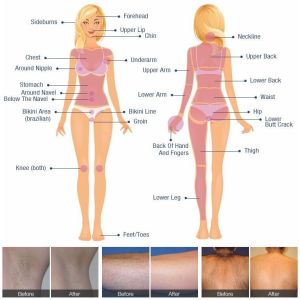 IPL SHR Diode Laser Hair Removal Face , Painless 3 Wave Ice Diode Laser