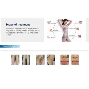 Laser Emitter Diode Laser Hair Removal Machine With 'In-Motion'