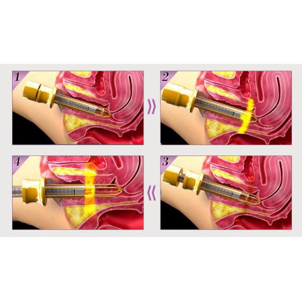 Accurate Treatment Laser face Resurfacing Machine Gynecology vaginal laser with 4pcs Probe