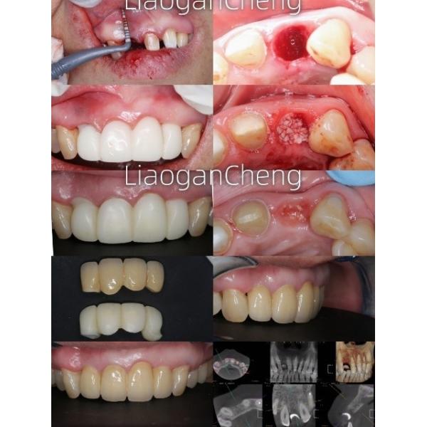 Quality Multilayered Gradient Technology Dental Zirconia Safe And Aesthetically Pleasing For Long-term wholesale