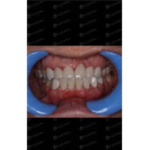 Yucera 98mm Open Precolored ST Color 16 Color Dental Zirconia Block for Dental