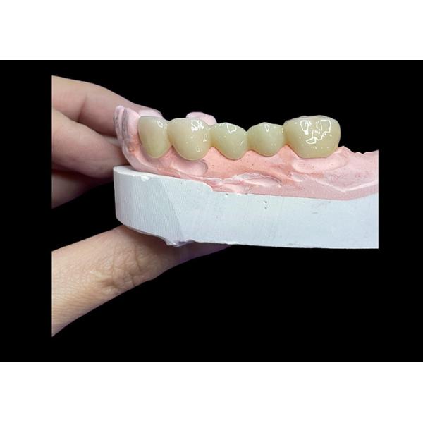 All Ceramic Crowns and Bridges Designed for Superior Aesthetics Durability and
