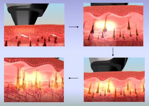 Trending hot products 808 diode laser hair removal beauty machine remove hair beauty equipment