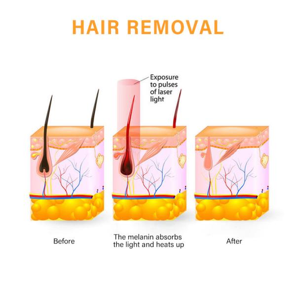 Permanent Depilation 808nm Diode Laser Machine , Korean Skin Permanent Epilation 808nm Diode Laser