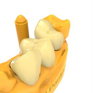 Low Temperature Expansion Coefficient Permanent Crown Resin Close to Natural