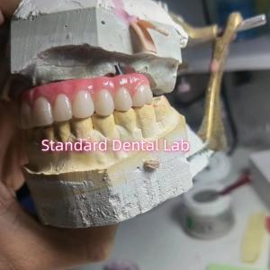 Screw Retained Titanium PMMA Dental Bridge Temporary Crown