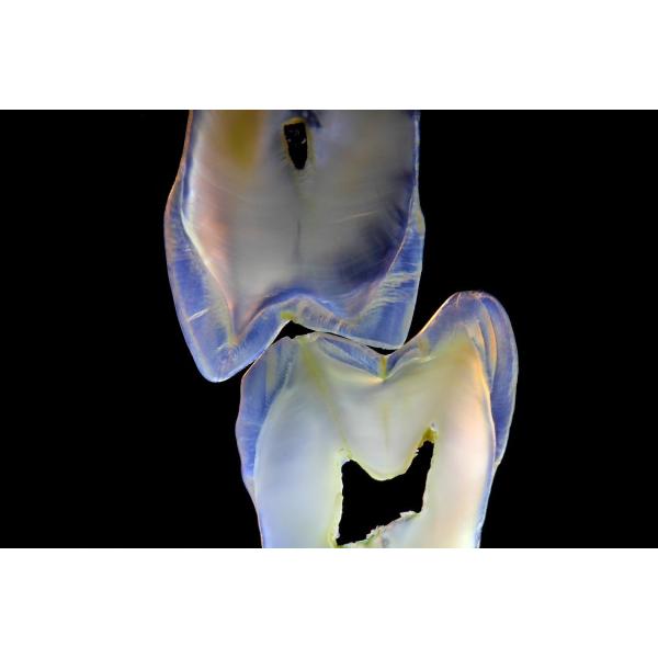 Quality Fixed Prosthetics Permanent Solution EMAX Dental Crown wholesale