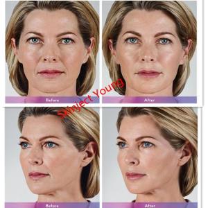 Juvederm Voluma 2x1ml Hyaluronic Acid Injectable Gel Fillers