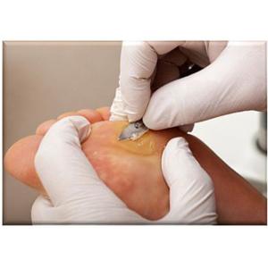 15 Watts Podiatry Laser 980nm Podiatrist Laser Treatment Toenail Fungus