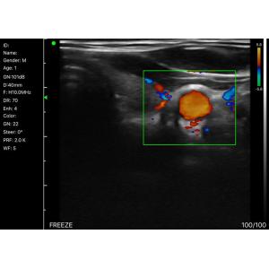 Home Doppler Ultrasound Portable Diagnostic Hand held Doppler Ultrasound
