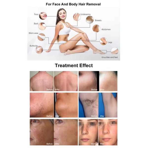 D32 Portable 808nm Professional Homeuse Diode Laser Hair Removal Machine Seeking Agents