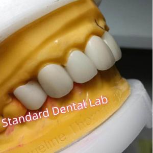 Ivoclar Zirconia Crown Veneers High Translucency Esthetic