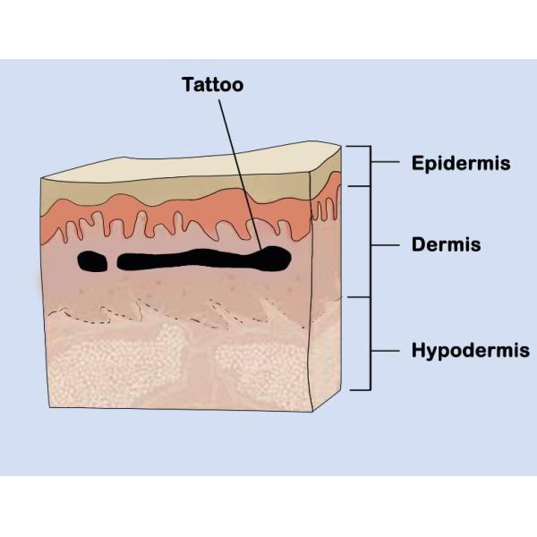 Version Picosecond Q Switched Nd Yag Laser Freckle Remove Acne Spot Removal