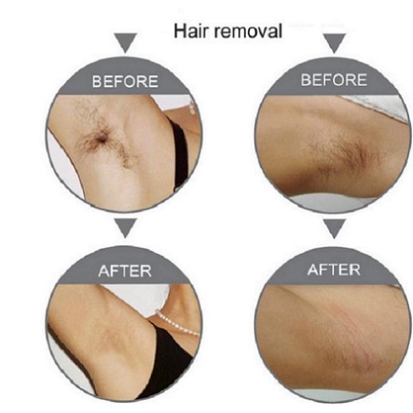 Laser hair removal machine 808nm Diode Laser Hair Removal Equipment For Women or Men