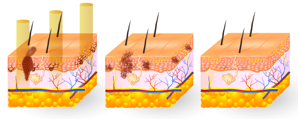 532 / 1064 Nm Laser Tattoo Removal Machine Anti - Puffiness With Aluminum Alloy Case