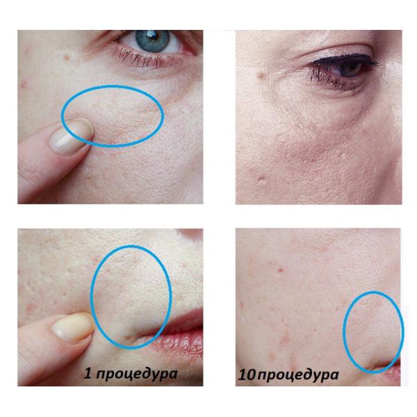 Microneedle Hydra Roller 64 Gold Tips dermal filler for hyaluronic acid facial massage derma roller bottle