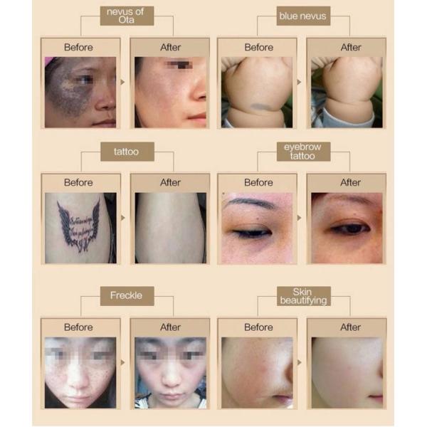 Nubway newest 1064&532nm  factory price picosecond laser tattoo machine 