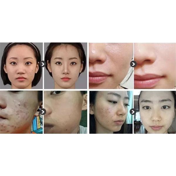 Home Use 7 In 1 Oxygen Microdermabrasion Machine Facial Beauty