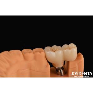 V Shaped Thread Type Finished Abutments Compatibility With All Major Implant