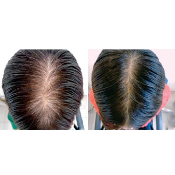 1360mw Laser Hair Growth Machine Laser Device For Hair Loss Problem