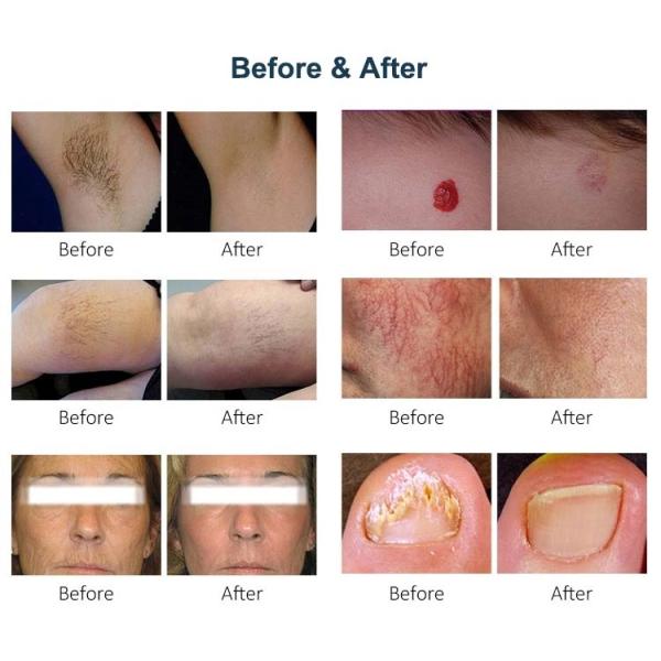 Alexandrite Diode Laser Hair Removal 755nm Alex Laser