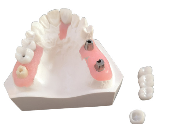Quality FDA All Zirconia Crown with Implant-Supported Dentures for Dental Lab wholesale