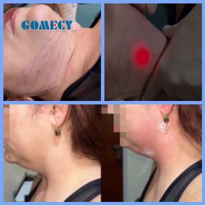 Endolift Laser Machine for Spider Veins/face Veins Removal and Lipolysis