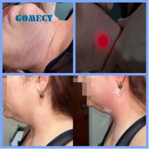 Endolift Laser Machine for Spider Veins/face Veins Removal and Lipolysis/Liposuction Fat Melting Pulse Duration 0-999s