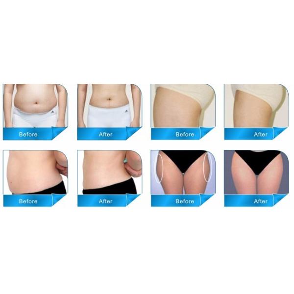 2016 Newest Model Ultrashape / Liposonix / HIFU Slimming Machine with good quality