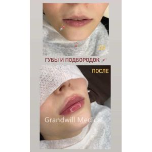 24mg/ml Injectable Hyaluronic Acid Dermal Filler For Wrinkle Smoothing