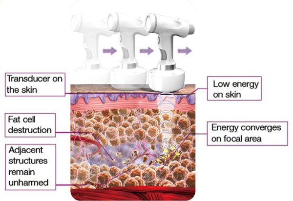 10Mhz liposonix hifu for fat reduction high intensity focused ultrasound 300W