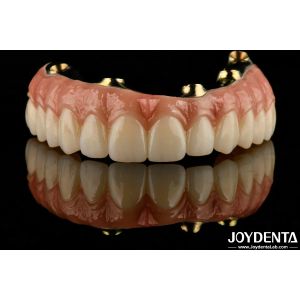 Natural Teeth And Gums Compatible Ti-Bar Zirconia Hybrid Bridge With High