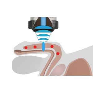 Eswt ED Shockwave Therapy Machine Shock Wave Physical Therapy Equipments