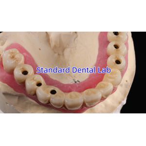 Multi Layer Zirconia Screw Retained Implant Bridge Biocompatible On Metal