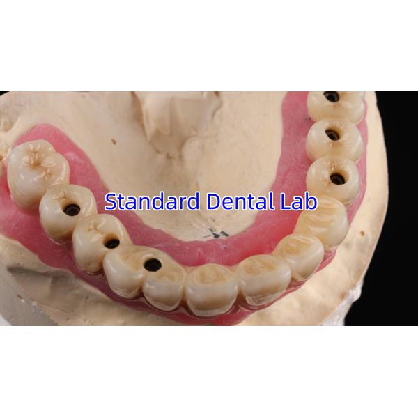 Multi Layer Zirconia Screw Retained Implant Bridge Biocompatible On Metal