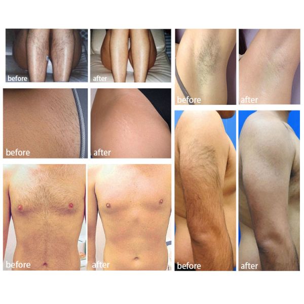 Fda Approved 808nm Diode Laser Hair Removal Beauty Machine