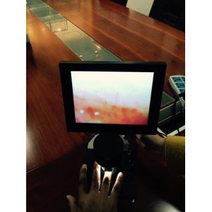 High Accuracy Nail Folding Microcirculation Microscope with High Definition