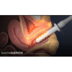 Radio Frequency RF Vaginal Rejuvenation Skin Non Surgical Noninvasive