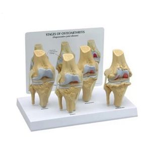 PVC Transparent Human Stage 4 Knee Pathology Joint Model For Studying